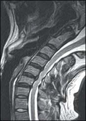Upright Dynamic MRI Reveals Hidden Disc Herniation